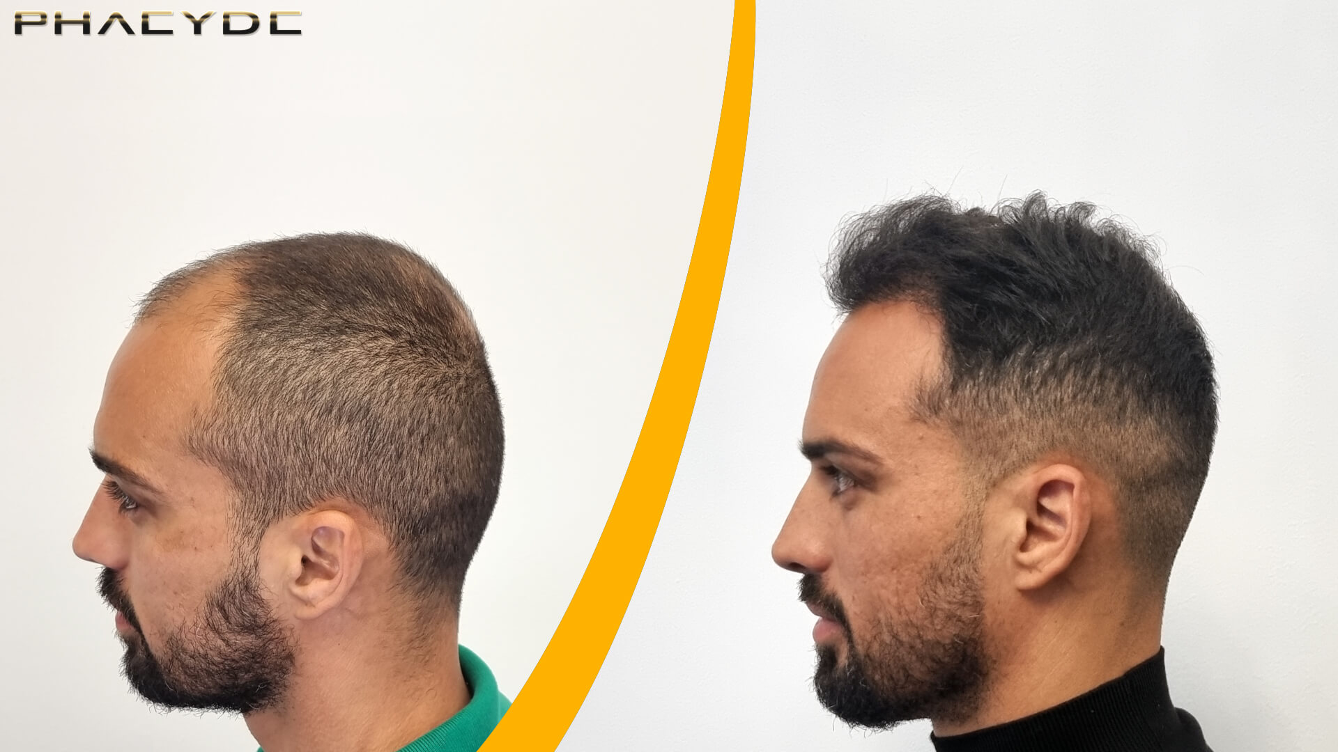 Трансплантација Косе - Резултат Пре и После