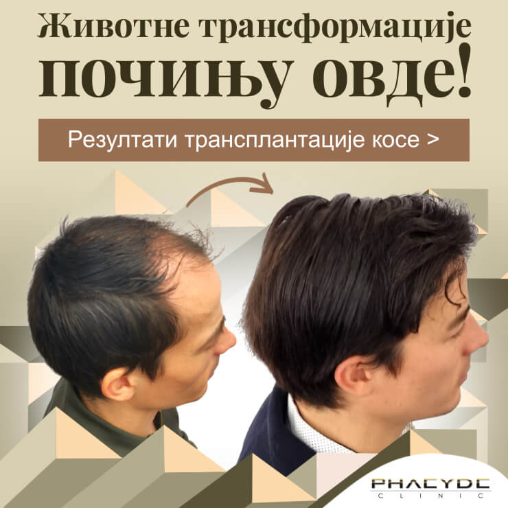 Трансплантација косе Бр . 1 трансплантације косе