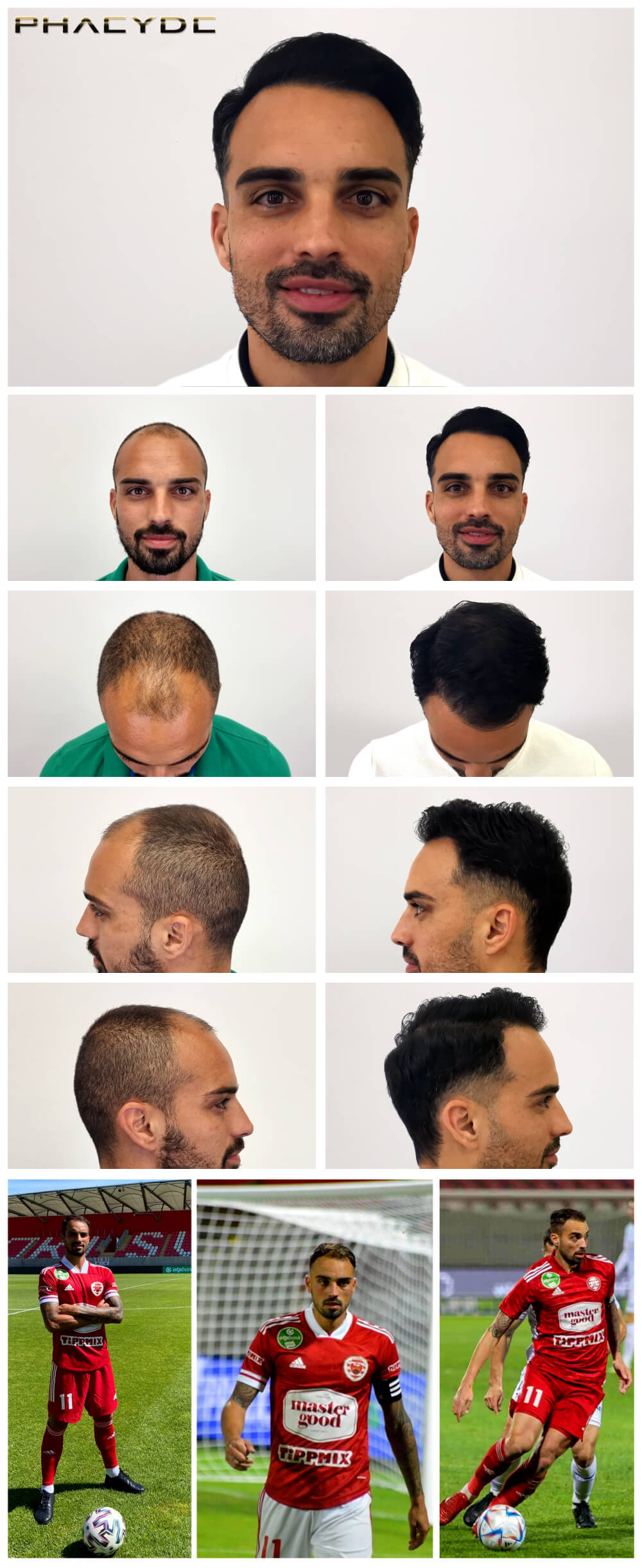 Lucas – 3600 Grafts