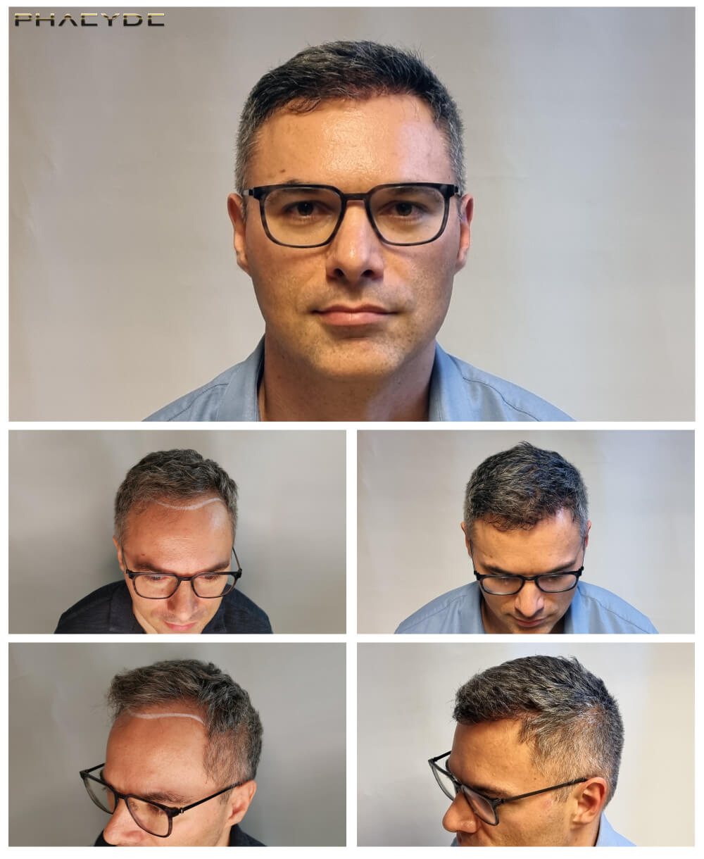 Pavel – 1400 Grafts