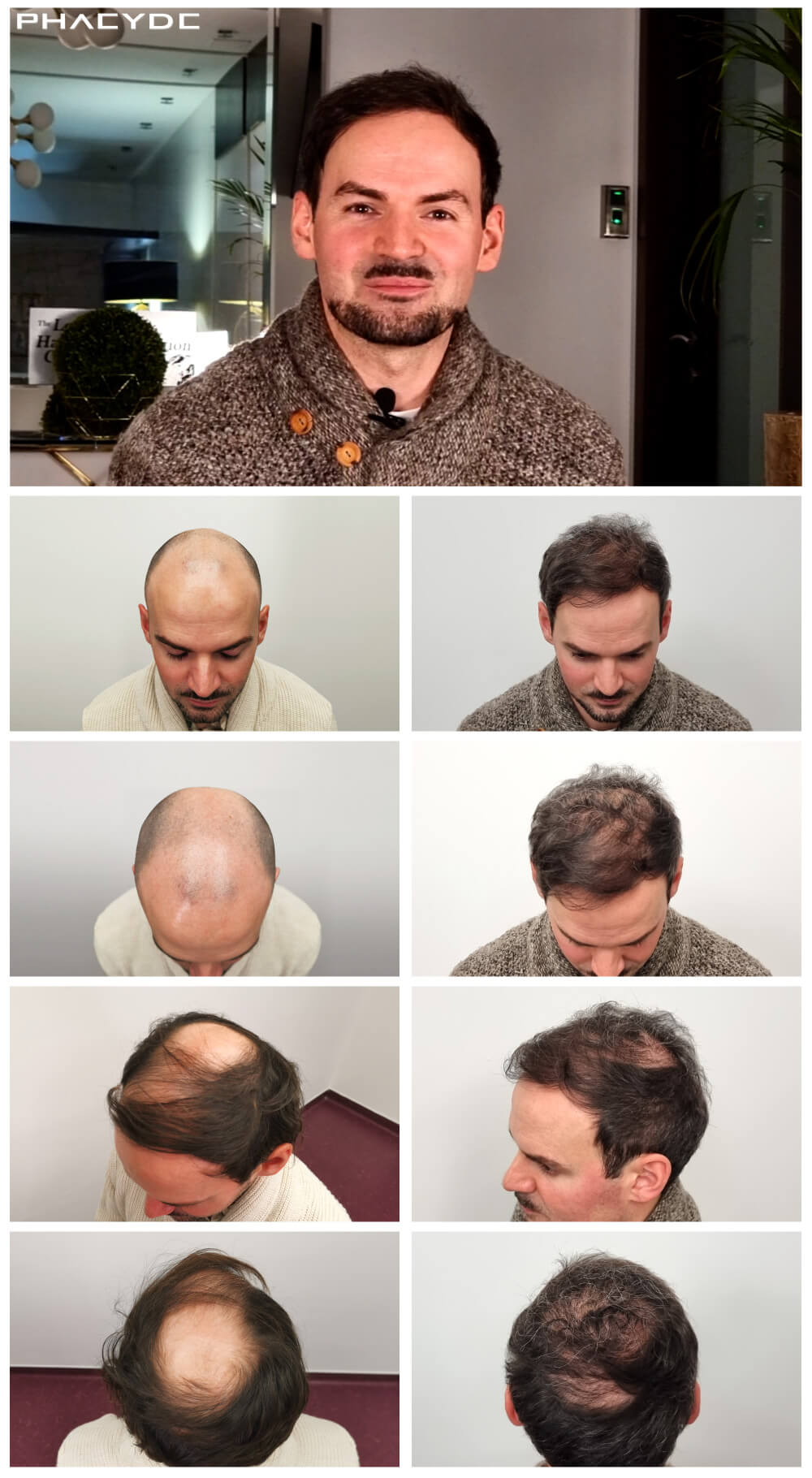 i/hair-transplantation/before-after-photos/hair-transplant-before-after-tamas-phaeyde-clinic.jpg