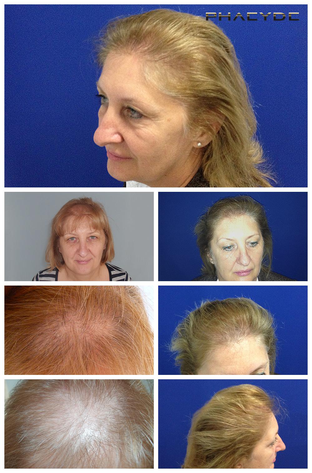 Рестаурација косе за жене